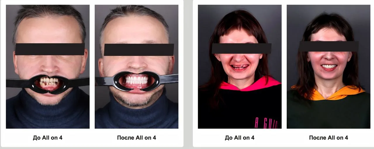 all-on-4 имплантация Крона Дент